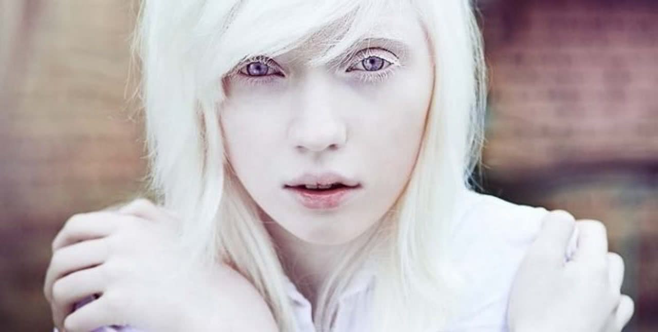 Albinism Pictures Photos